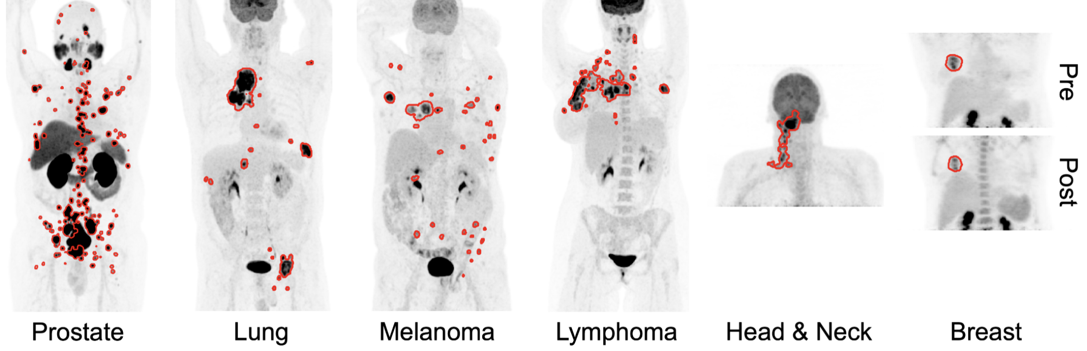 Cancer Imaging Analysis 